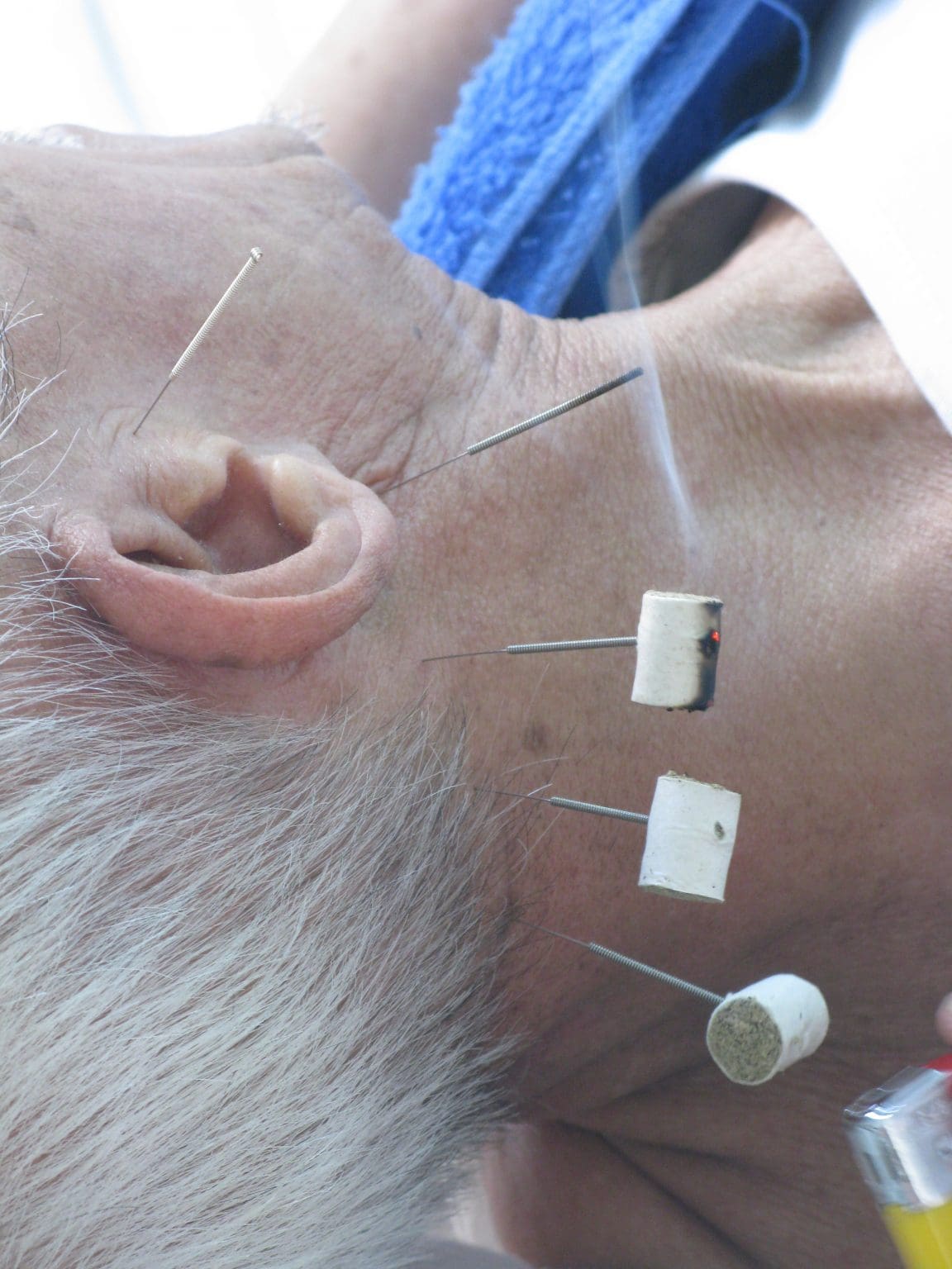 Acupuncture River City Wellness