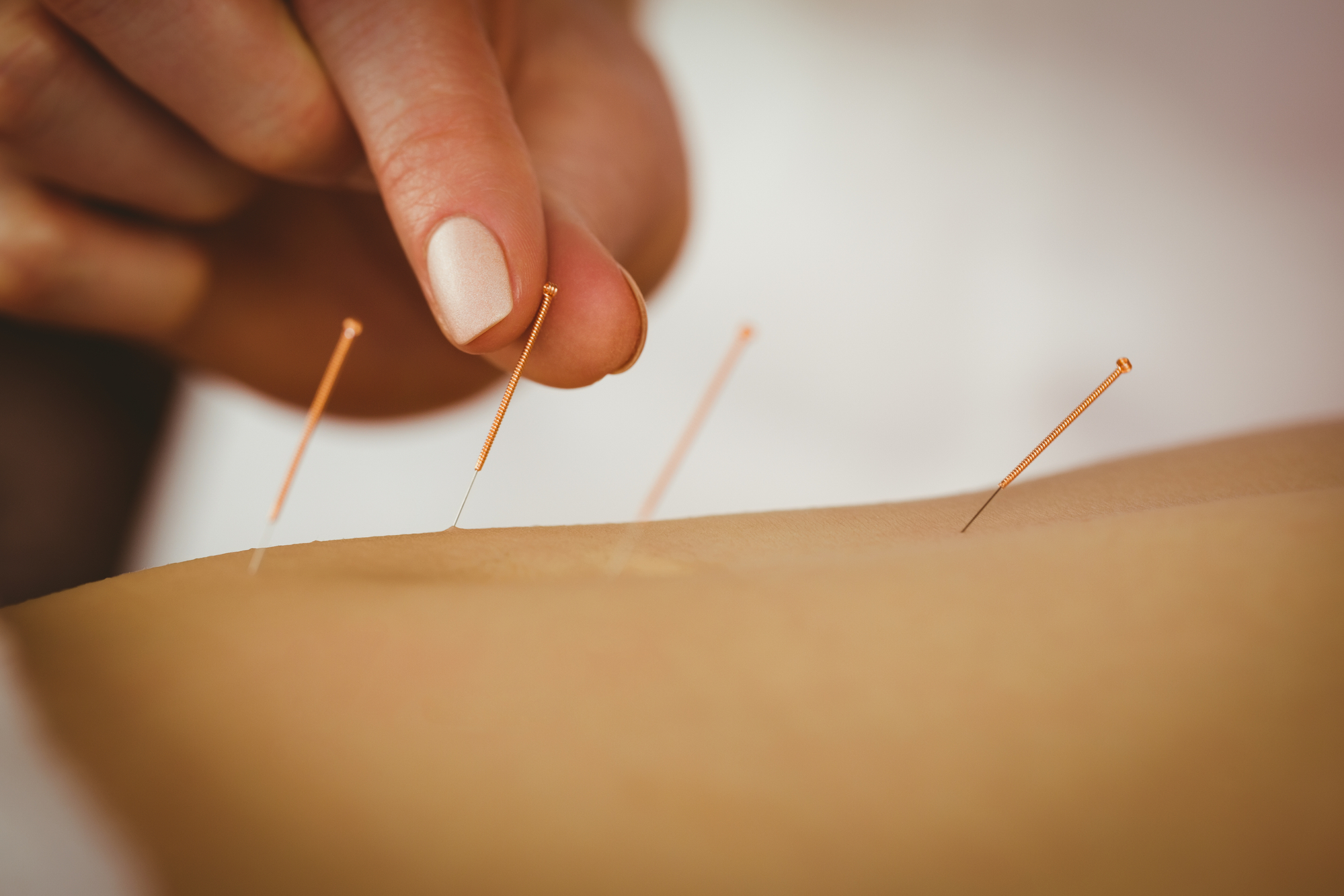 Natural Relief for Sciatica Pain: Acupuncture