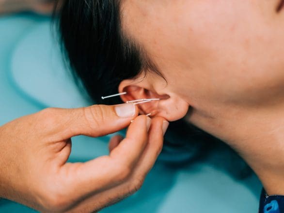 Acupuncture in ear