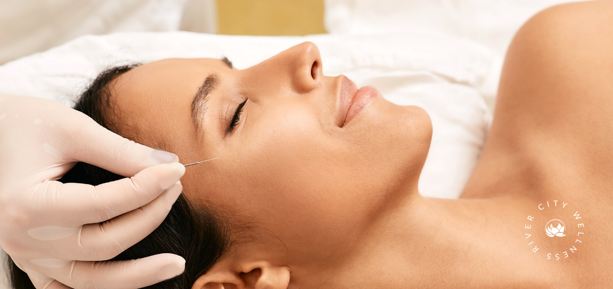 Bell's Palsy Treatment with Acupuncture