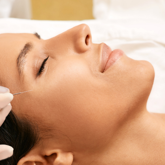 Bell's Palsy Treatment with Acupuncture
